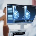 Aumento del cáncer de seno en mujeres más jóvenes: surgiría una ampliación de la detección en la parte inferior de 50 años