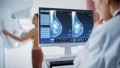 Aumento del cáncer de seno en mujeres más jóvenes: surgiría una ampliación de la detección en la parte inferior de 50 años
