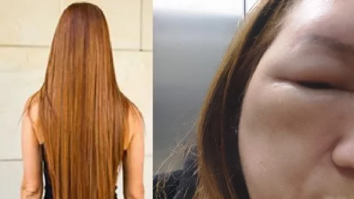 se le inflamó el cráneo y su cara