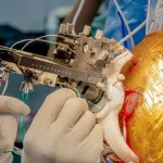 Novedoso experimento médico en Latinoamérica: implantan chips de manera simultánea en el cerebro para mejorar síntomas del Parkinson