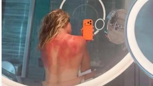 “El sol de Australia no es broma”: la foto de una tenista mexicana que muestra el riesgo en el país con las tasas de cáncer de piel más altas del mundo | Internacional | Noticias
